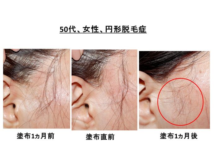 円形脱毛症　病院